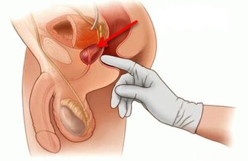 prosztata masszázs prosztatagyulladás esetén